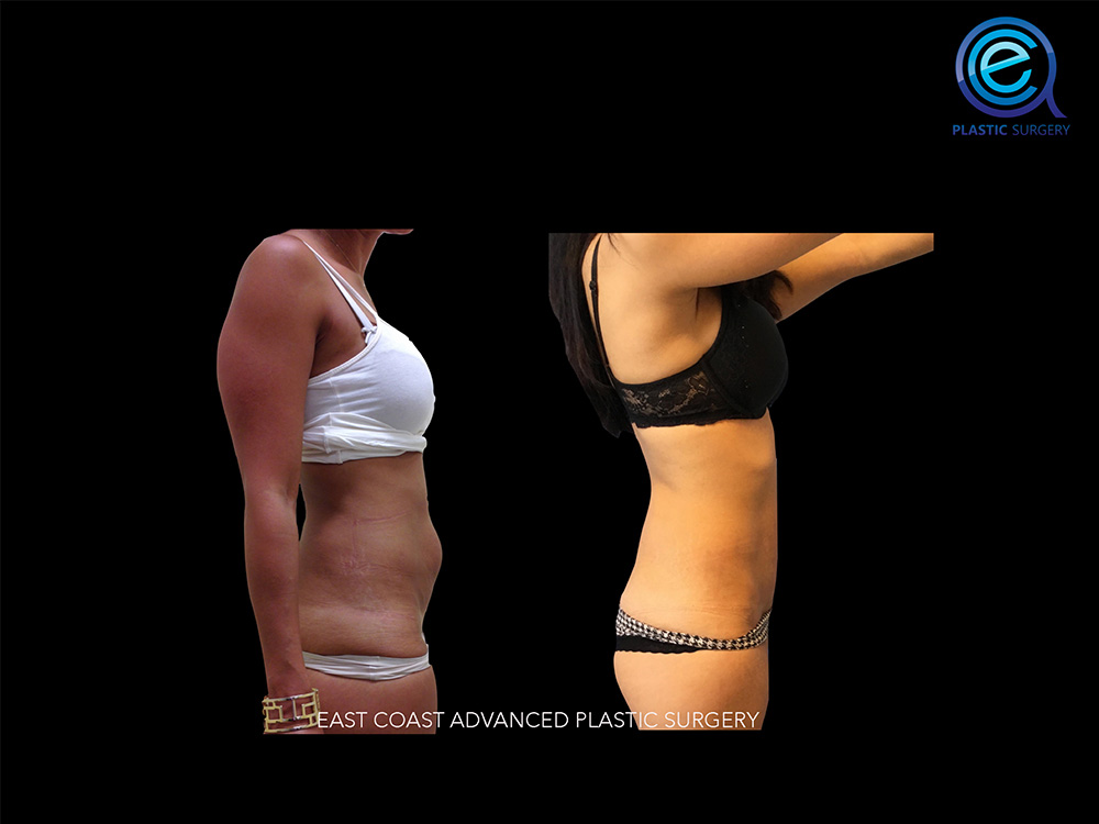 Real patient Abdominoplasty Tummy Tuck by ECA Plastic Surgery, New Jersey