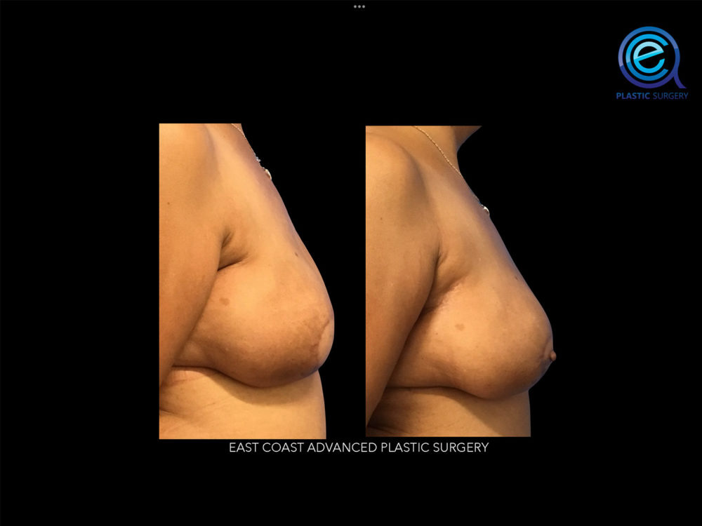 Real patient Breast Reconstruction by ECA Plastic Surgery, New Jersey