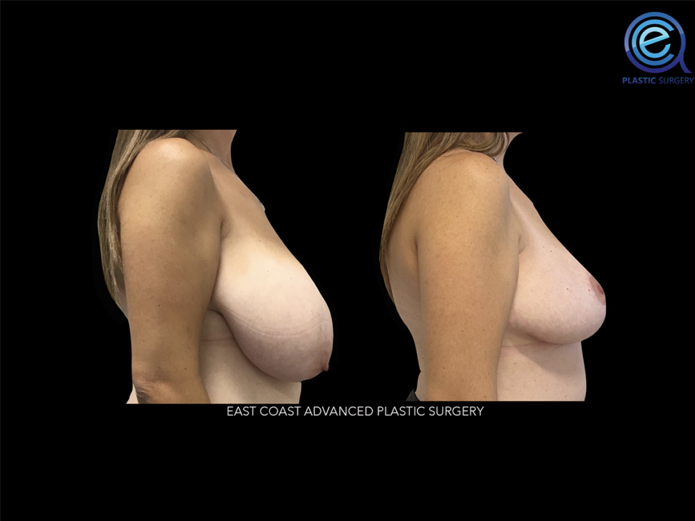 Real patient Breast Reduction by ECA Plastic Surgery, New Jersey