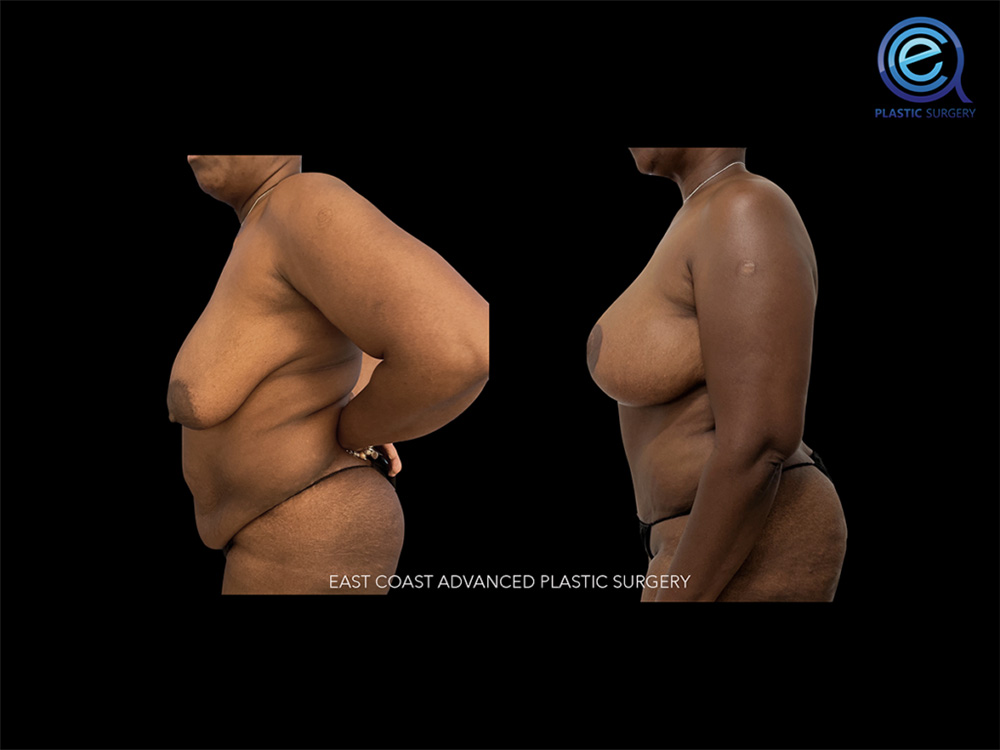 Real patient Breast Reconstruction by ECA Plastic Surgery, New Jersey
