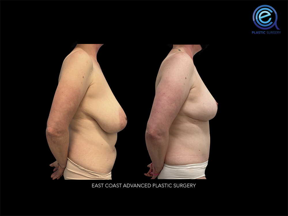 Real patient Breast Reconstruction by ECA Plastic Surgery, New Jersey