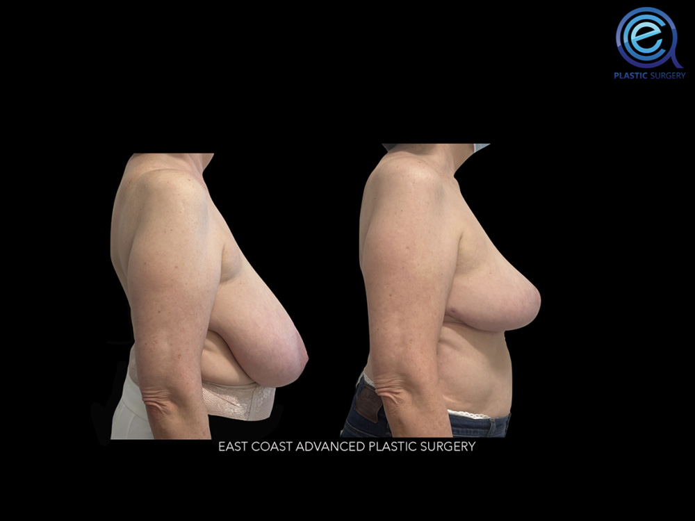Real patient Breast Reduction by ECA Plastic Surgery, New Jersey
