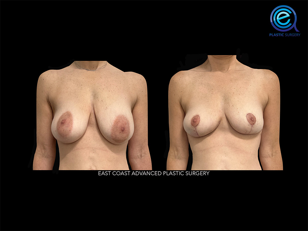 Real patient Breast Reconstruction by ECA Plastic Surgery, New Jersey