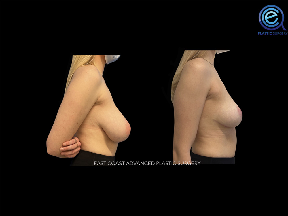 Real patient Breast Reduction by ECA Plastic Surgery, New Jersey