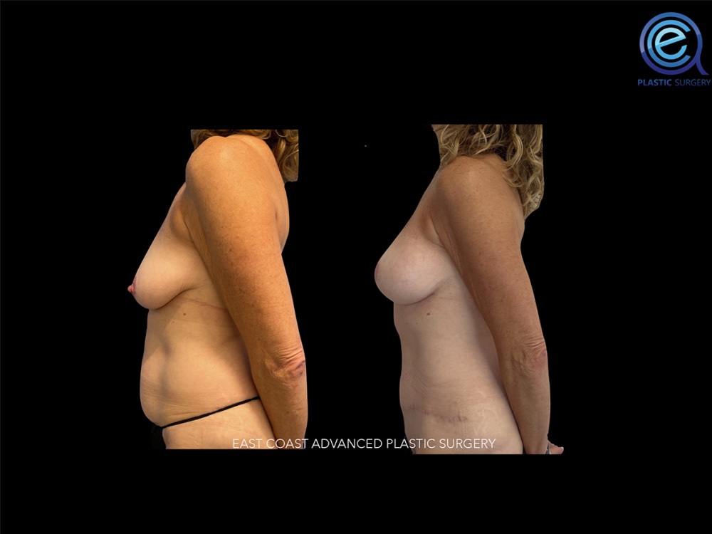 Real patient Breast Reconstruction by ECA Plastic Surgery, New Jersey