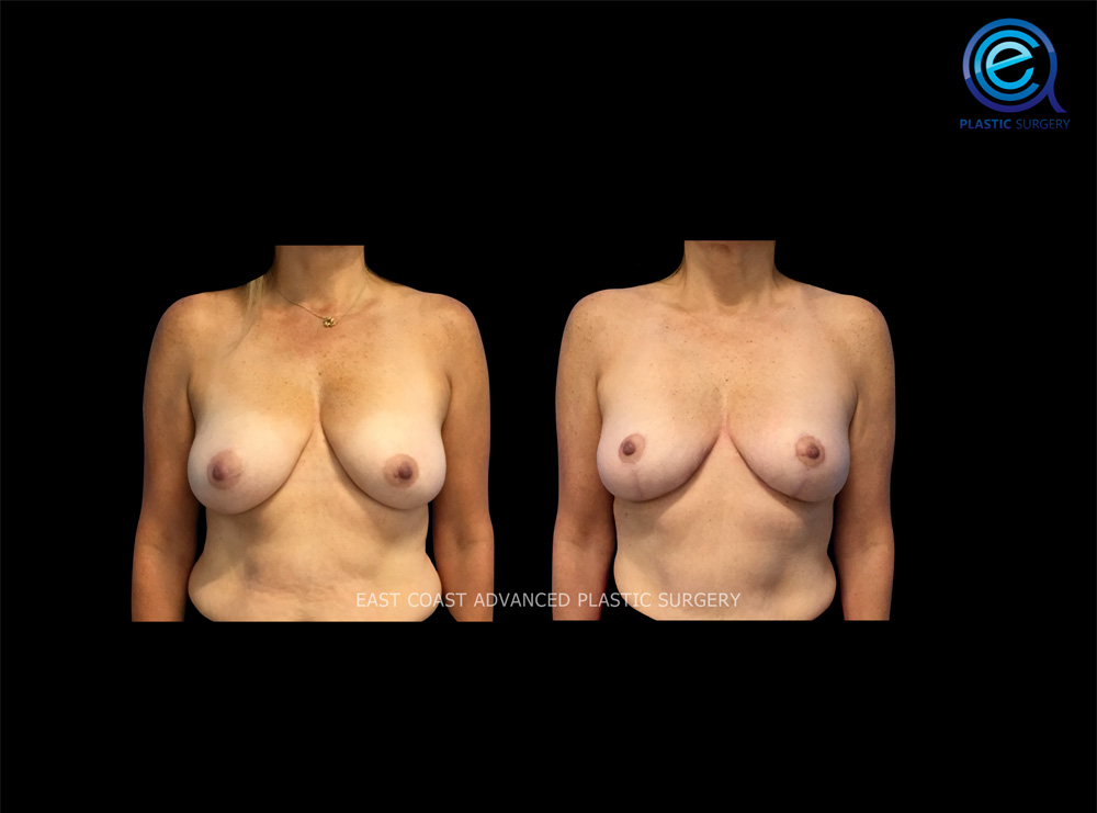Real patient Breast Reduction by ECA Plastic Surgery, New Jersey