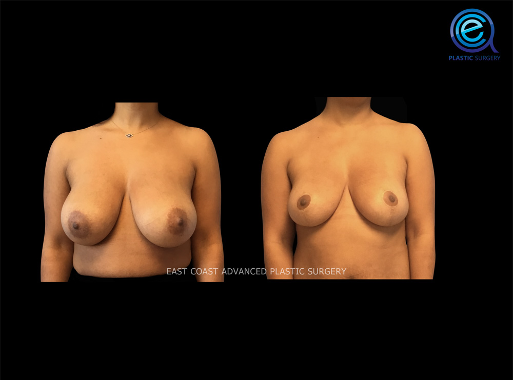 Real patient Breast Reduction by ECA Plastic Surgery, New Jersey
