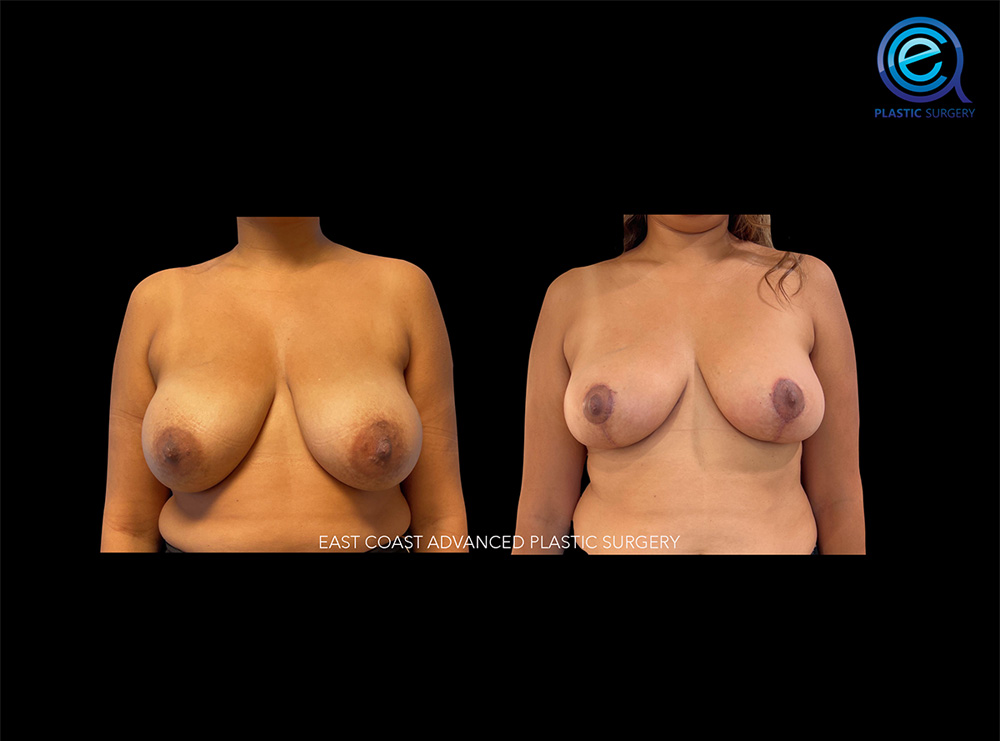 Real patient Breast Reduction by ECA Plastic Surgery, New Jersey