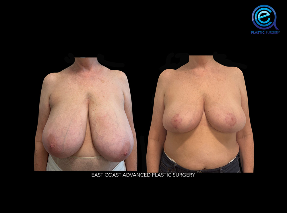 Real patient Breast Reduction by ECA Plastic Surgery, New Jersey