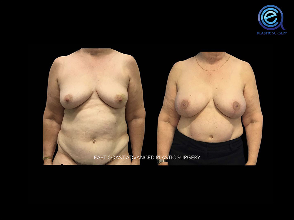 Real patient Breast Reconstruction by ECA Plastic Surgery, New Jersey