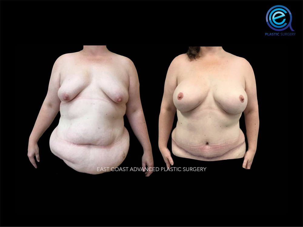 Real patient Breast Reconstruction by ECA Plastic Surgery, New Jersey