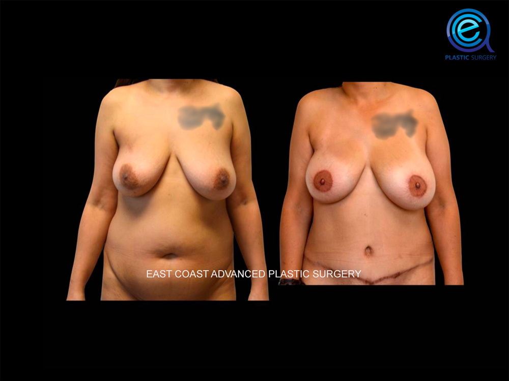 Real patient Breast Reconstruction by ECA Plastic Surgery, New Jersey