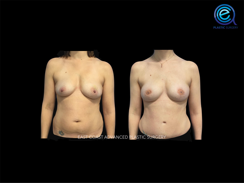 Real patient Breast Reconstruction by ECA Plastic Surgery, New Jersey