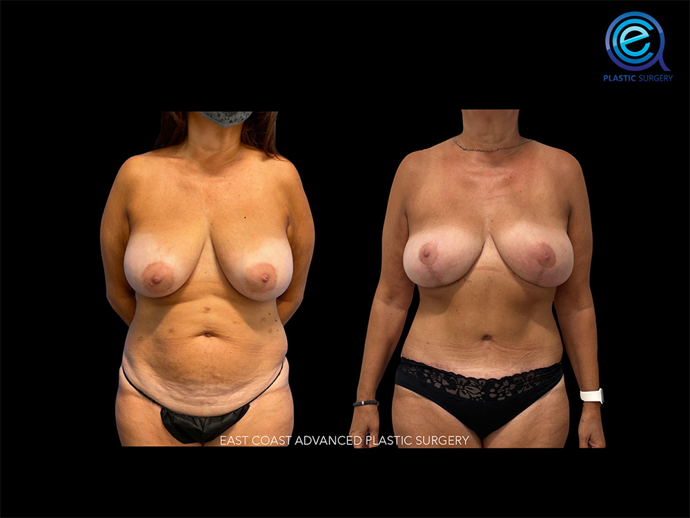 Real patient Breast Reconstruction by ECA Plastic Surgery, New Jersey