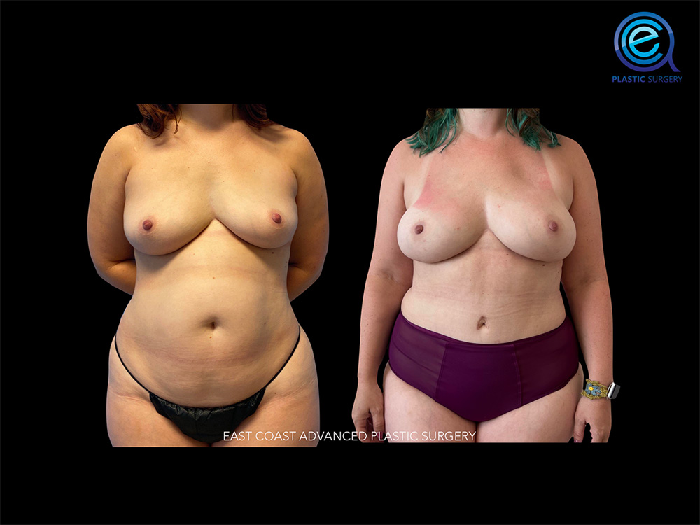 Real patient Breast Reconstruction by ECA Plastic Surgery, New Jersey
