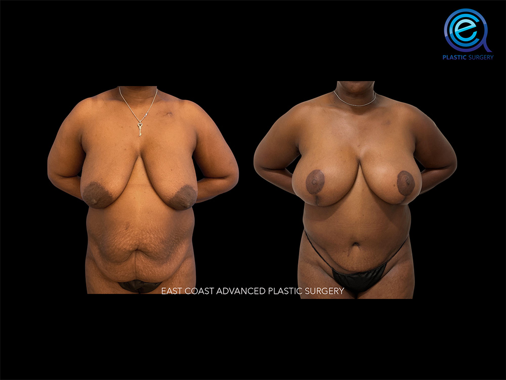 Real patient Breast Reconstruction by ECA Plastic Surgery, New Jersey