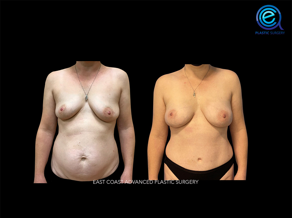 Real patient Breast Reconstruction by ECA Plastic Surgery, New Jersey