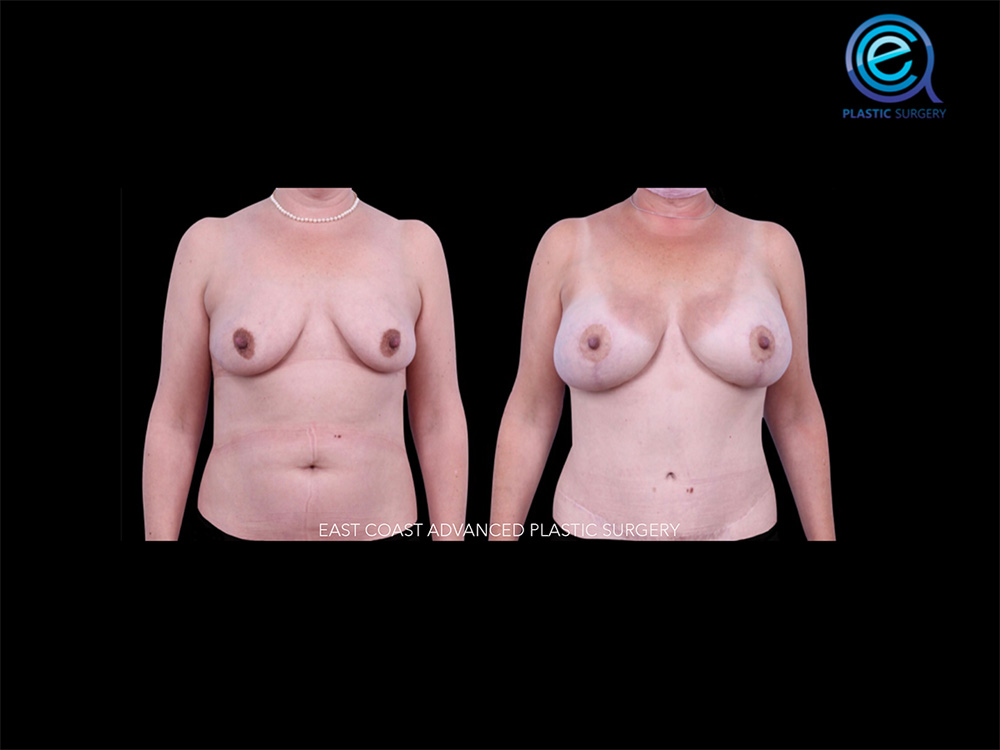 Real patient Breast Reconstruction by ECA Plastic Surgery, New Jersey