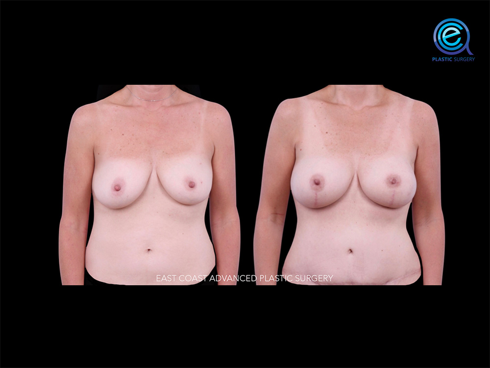 Real patient Breast Reconstruction by ECA Plastic Surgery, New Jersey