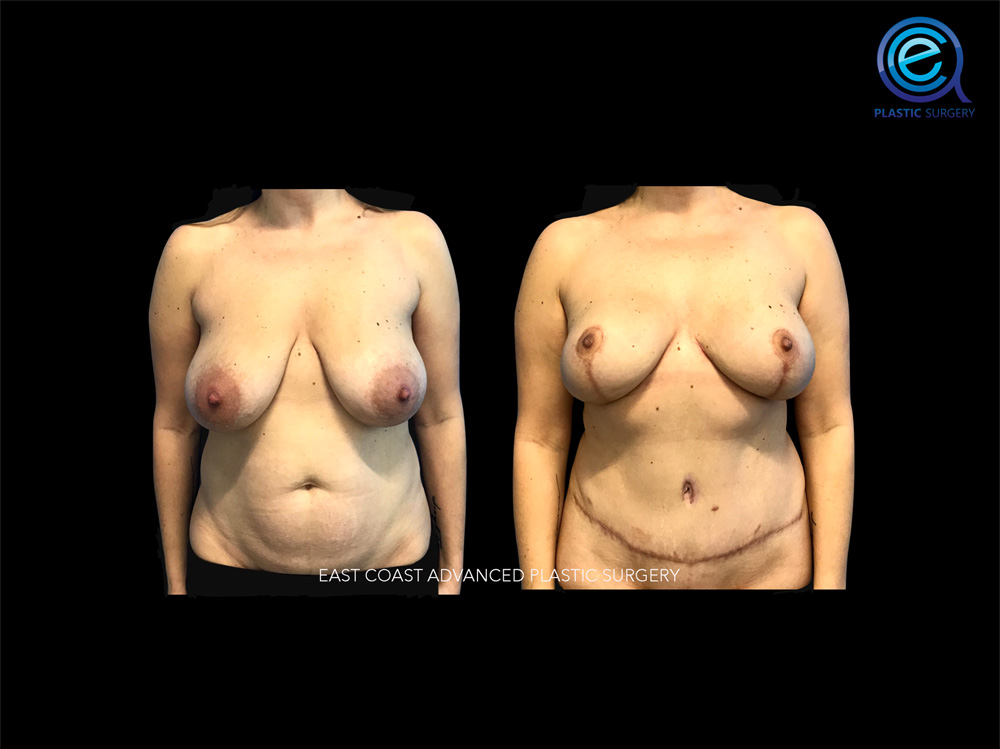 Real patient Breast Reconstruction by ECA Plastic Surgery, New Jersey