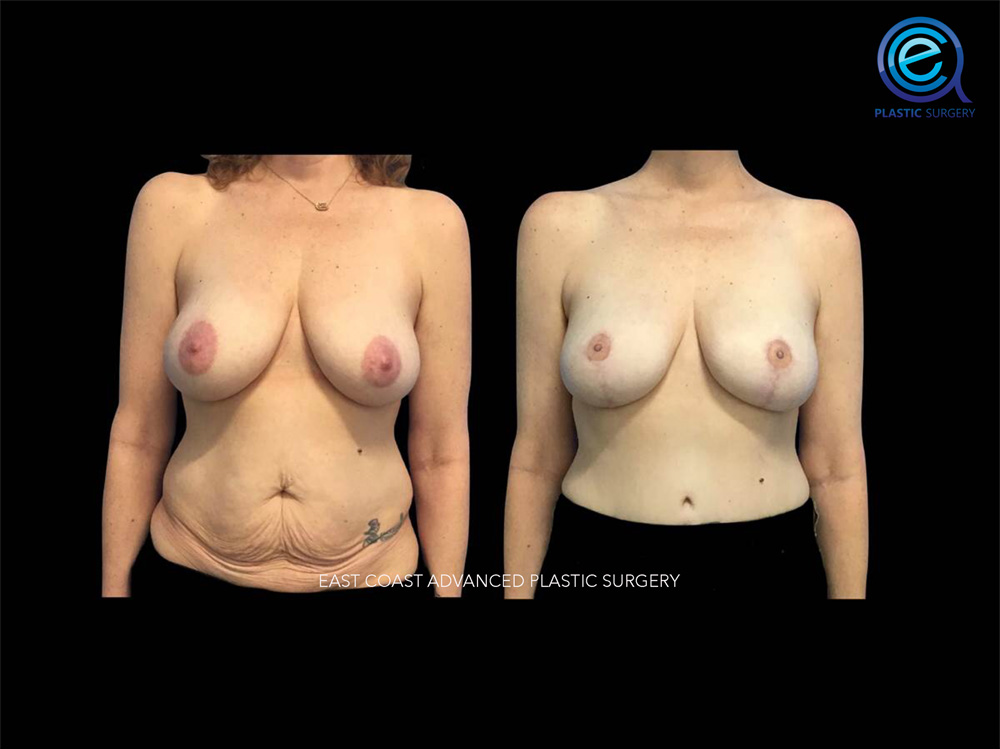 Real patient Breast Reconstruction by ECA Plastic Surgery, New Jersey