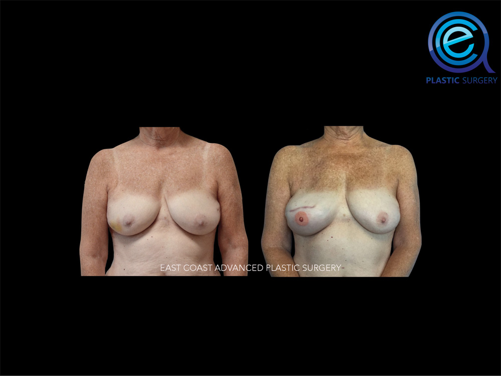 Real patient Breast Reconstruction by ECA Plastic Surgery, New Jersey