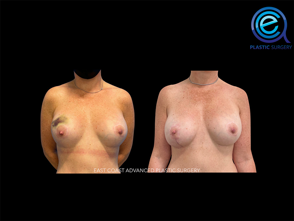 Real patient Breast Reconstruction by ECA Plastic Surgery, New Jersey