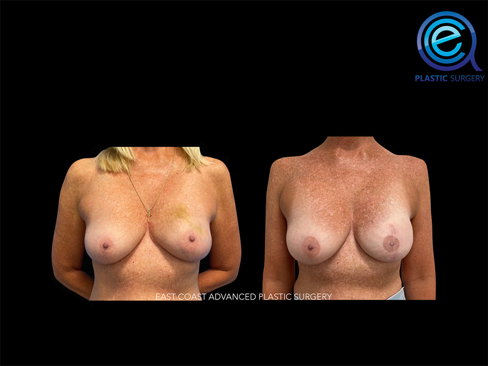 Real patient Breast Reconstruction by ECA Plastic Surgery, New Jersey