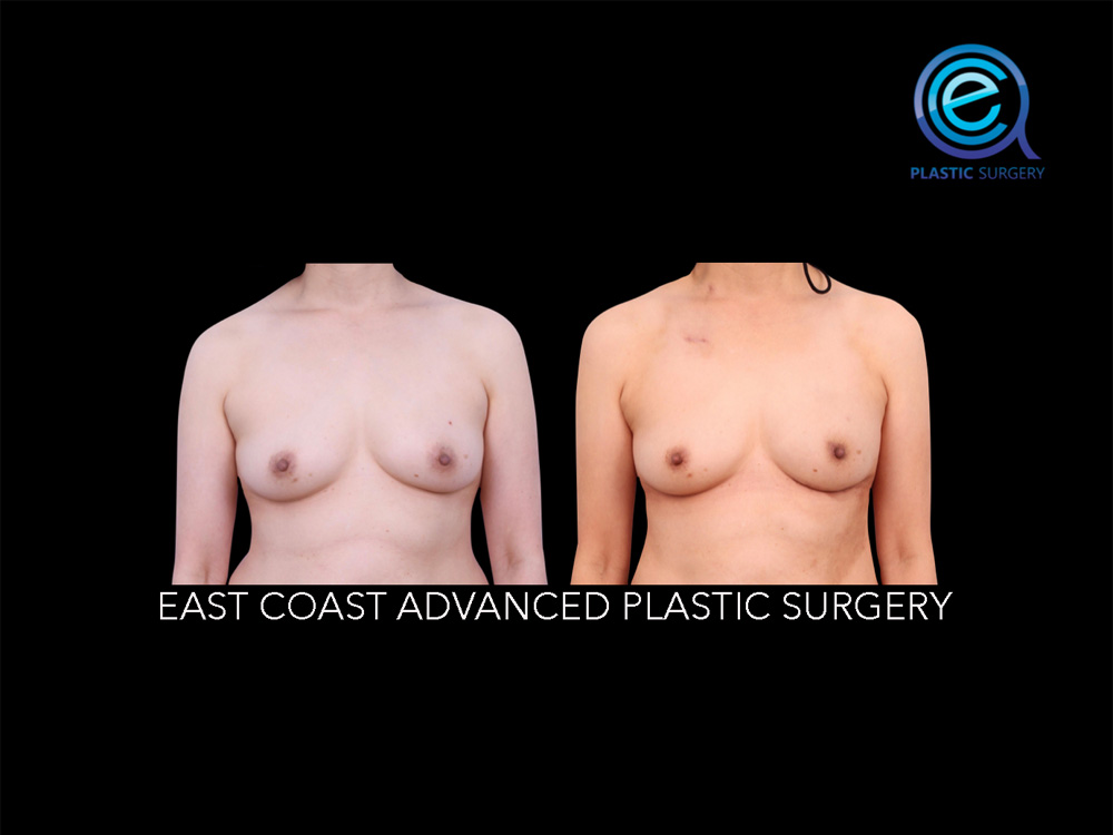 Real patient Breast Reconstruction by ECA Plastic Surgery, New Jersey