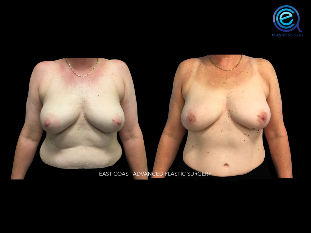 Real patient Breast Reconstruction by ECA Plastic Surgery, New Jersey