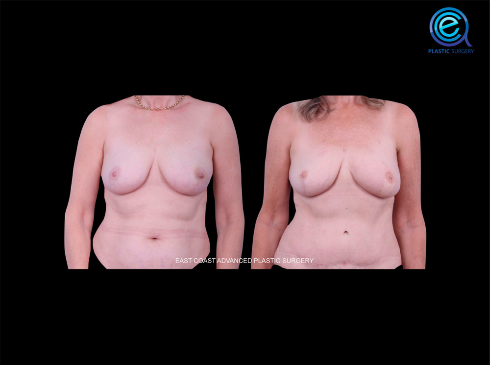 Real patient Breast Reconstruction by ECA Plastic Surgery, New Jersey