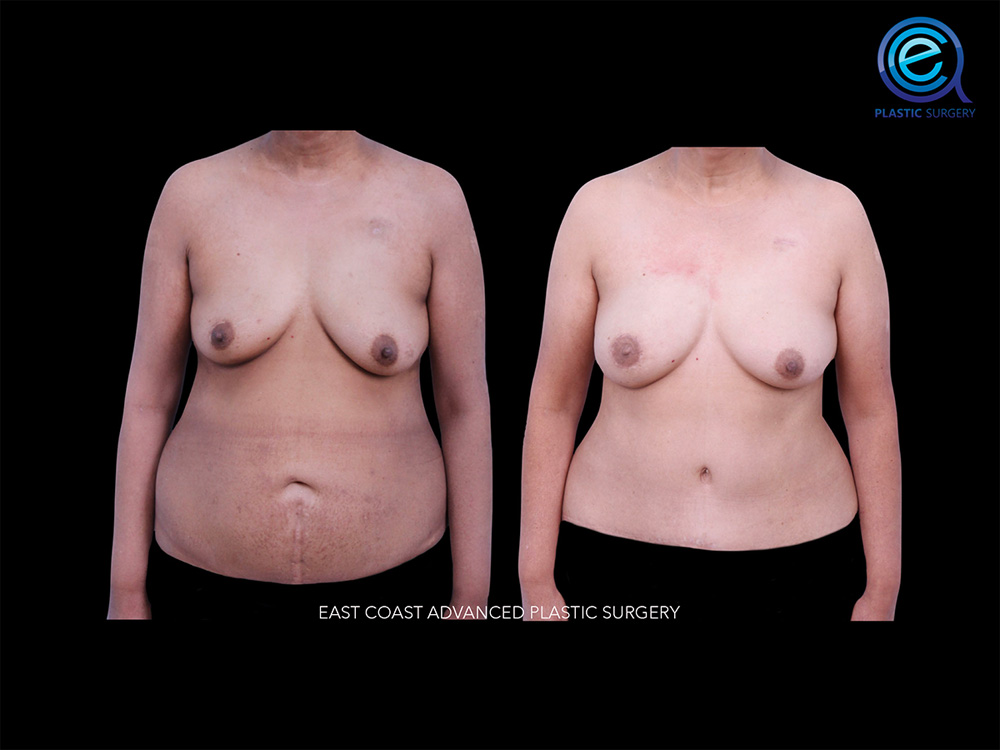 Real patient Breast Reconstruction by ECA Plastic Surgery, New Jersey