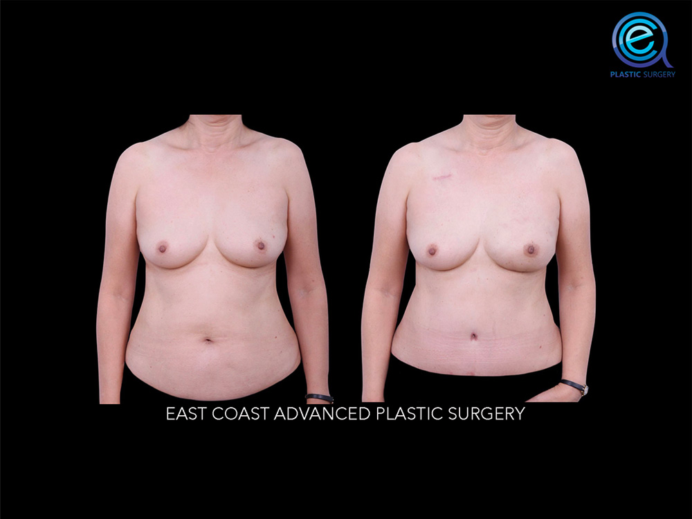 Real patient Breast Reconstruction by ECA Plastic Surgery, New Jersey