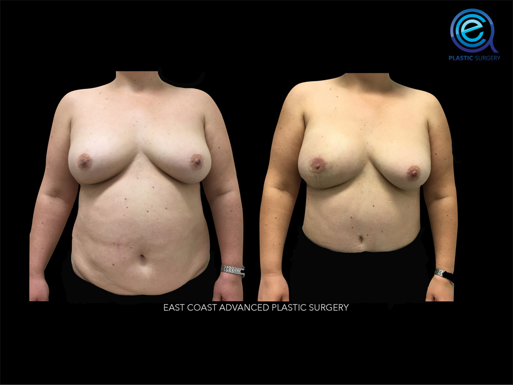 Real patient Breast Reconstruction by ECA Plastic Surgery, New Jersey