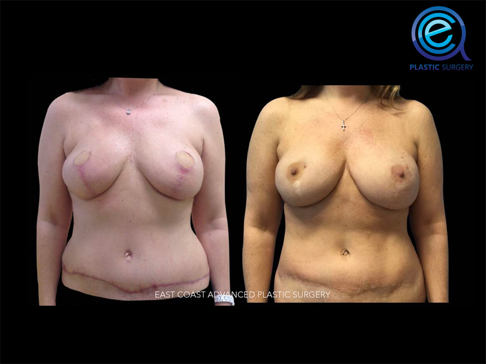 Real patient Breast Reconstruction by ECA Plastic Surgery, New Jersey