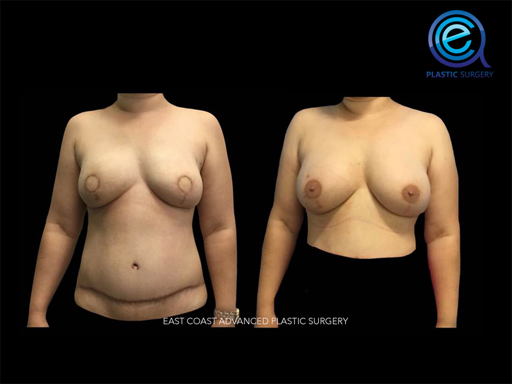 Real patient Breast Reconstruction by ECA Plastic Surgery, New Jersey