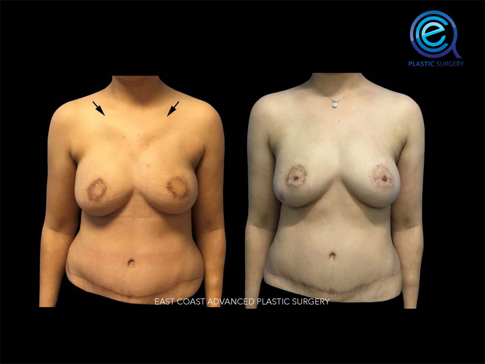 Real patient Breast Reconstruction by ECA Plastic Surgery, New Jersey