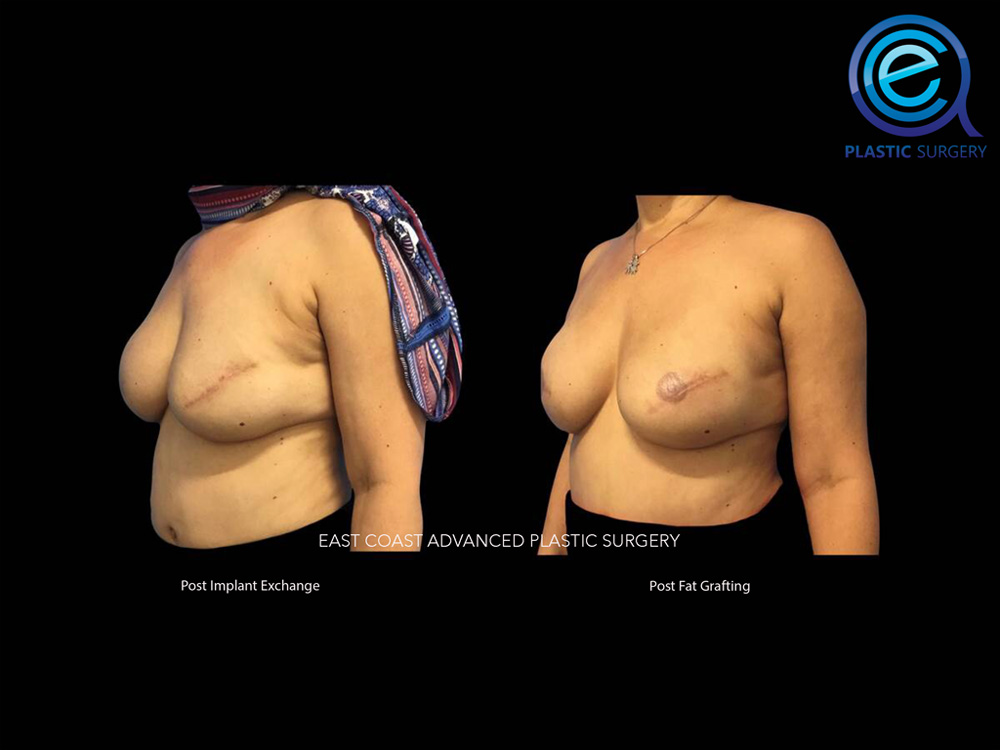 Real patient Breast Reconstruction by ECA Plastic Surgery, New Jersey