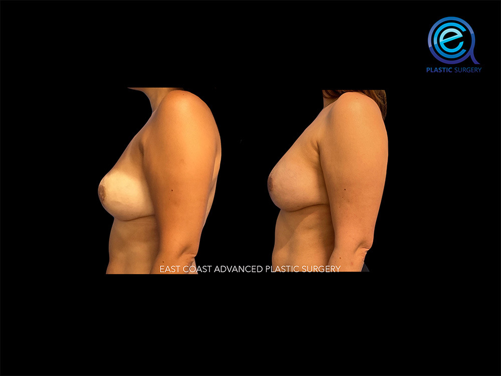 Real patient Breast Reconstruction by ECA Plastic Surgery, New Jersey
