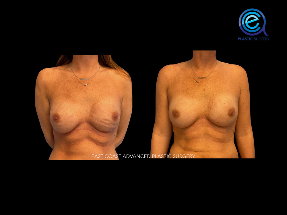 Real patient Breast Reconstruction by ECA Plastic Surgery, New Jersey