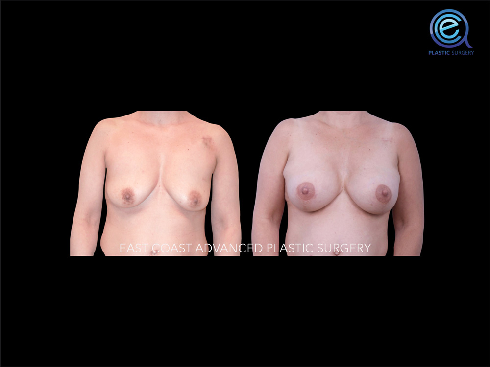 Real patient Breast Reconstruction by ECA Plastic Surgery, New Jersey