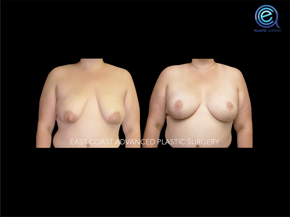 Real patient Breast Reconstruction by ECA Plastic Surgery, New Jersey