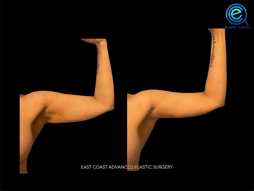Real patient Brachioplasty Arm Lift by ECA Plastic Surgery, New Jersey