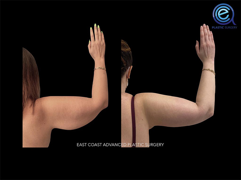 Real patient Brachioplasty Arm Lift by ECA Plastic Surgery, New Jersey