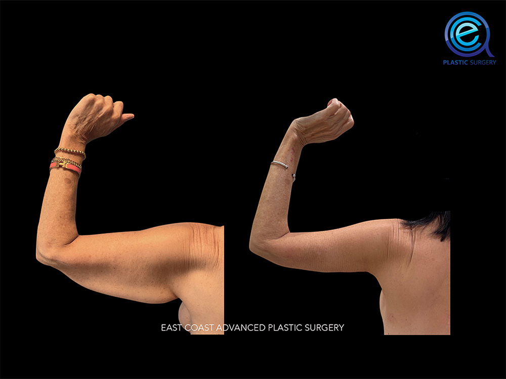 Real patient Brachioplasty Arm Lift by ECA Plastic Surgery, New Jersey