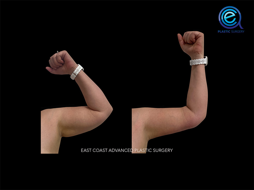 Real patient Brachioplasty Arm Lift by ECA Plastic Surgery, New Jersey