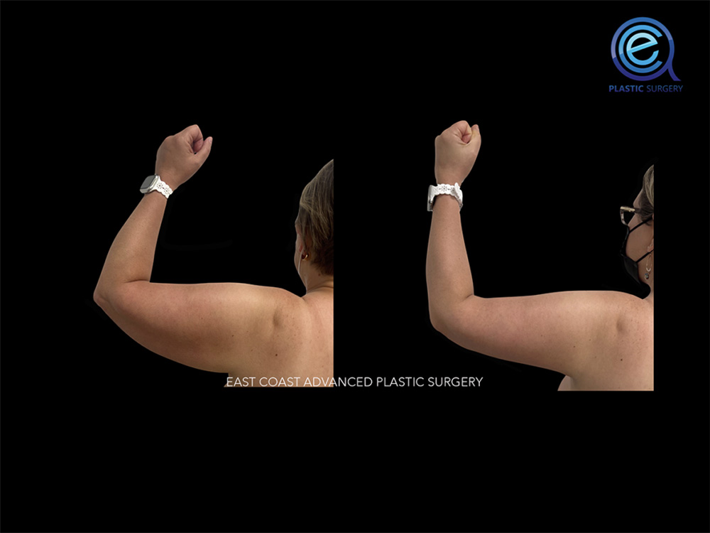 Real patient Brachioplasty Arm Lift by ECA Plastic Surgery, New Jersey