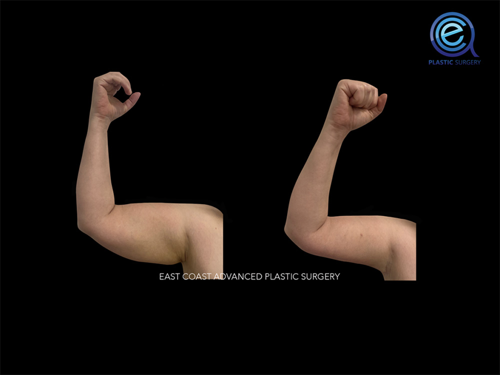Real patient Brachioplasty Arm Lift by ECA Plastic Surgery, New Jersey