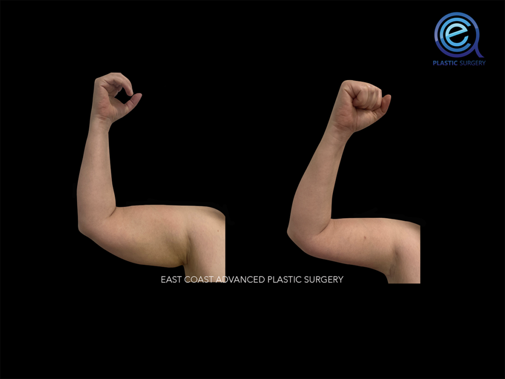 Real patient Brachioplasty Arm Lift by ECA Plastic Surgery, New Jersey