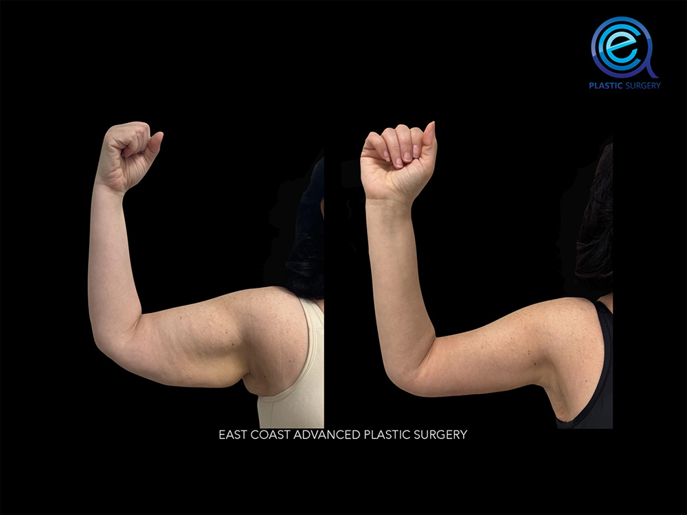 Real patient Brachioplasty Arm Lift by ECA Plastic Surgery, New Jersey
